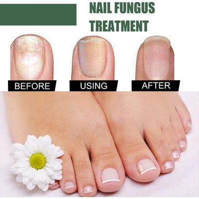 Nail Fungus Solution